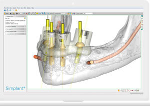 シンプラントによる事前シミュレーションの実施と補綴主導型インプラント治療