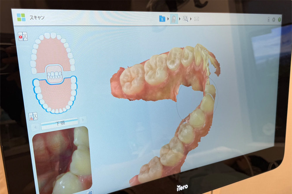 患者さまの負担を軽減する口腔内スキャナー