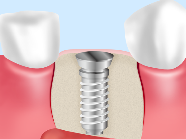 インプラント埋入