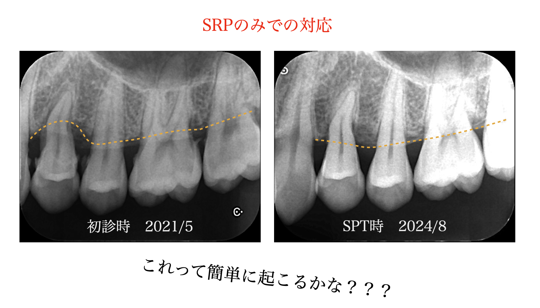 SRP（非外科治療）で生じる骨再生の可能性　