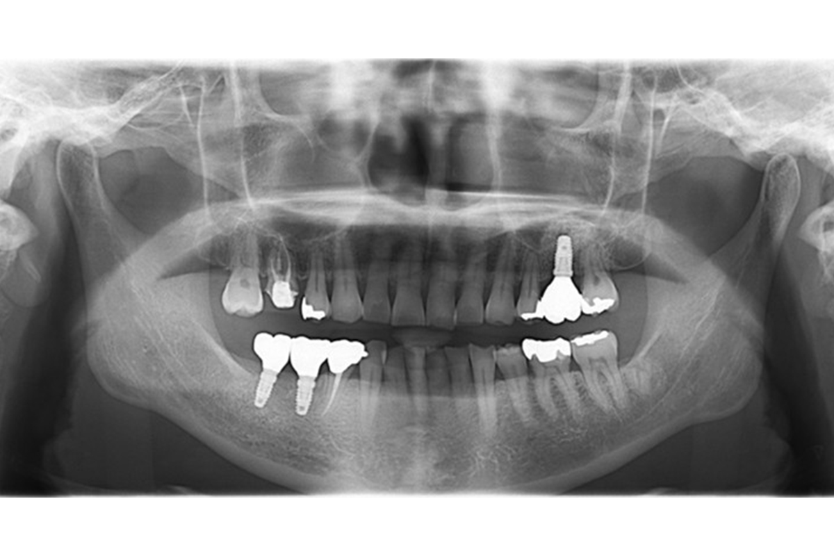 他院でインプラント治療を断られた方へ