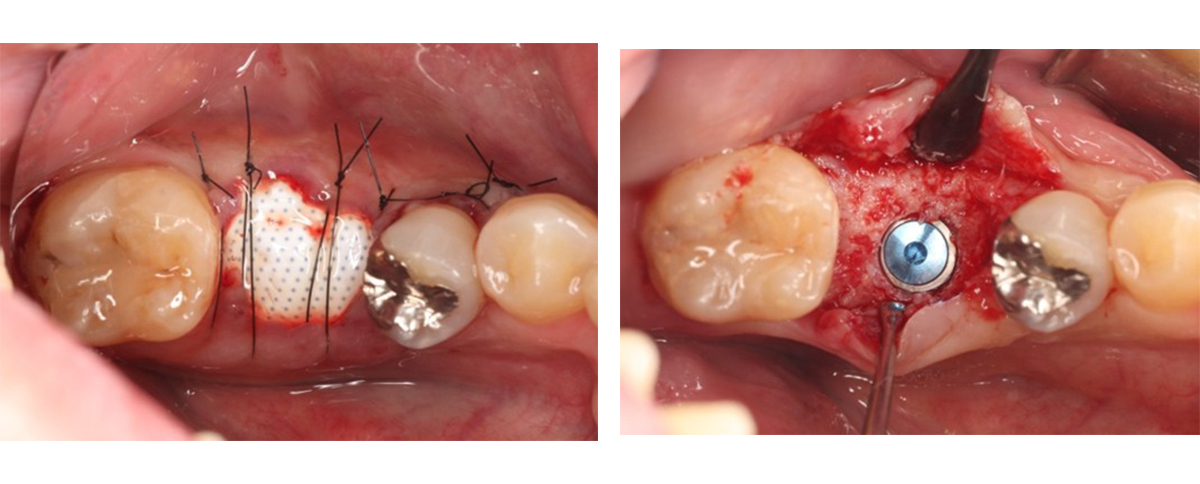 インプラント治療の症例画像「オープンバリアメンブレンを用いた症例」