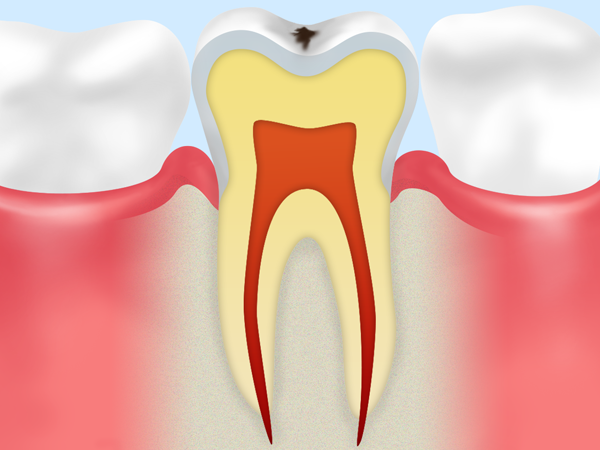 C1：初期の虫歯