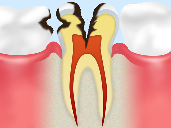 C3：神経まで進行した虫歯