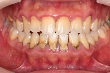 「中等度歯周病」が　歯科衛生士による歯周基本治療で改善