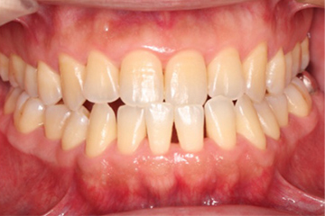 「中等度歯周病」が　歯科衛生士による歯周基本治療で改善