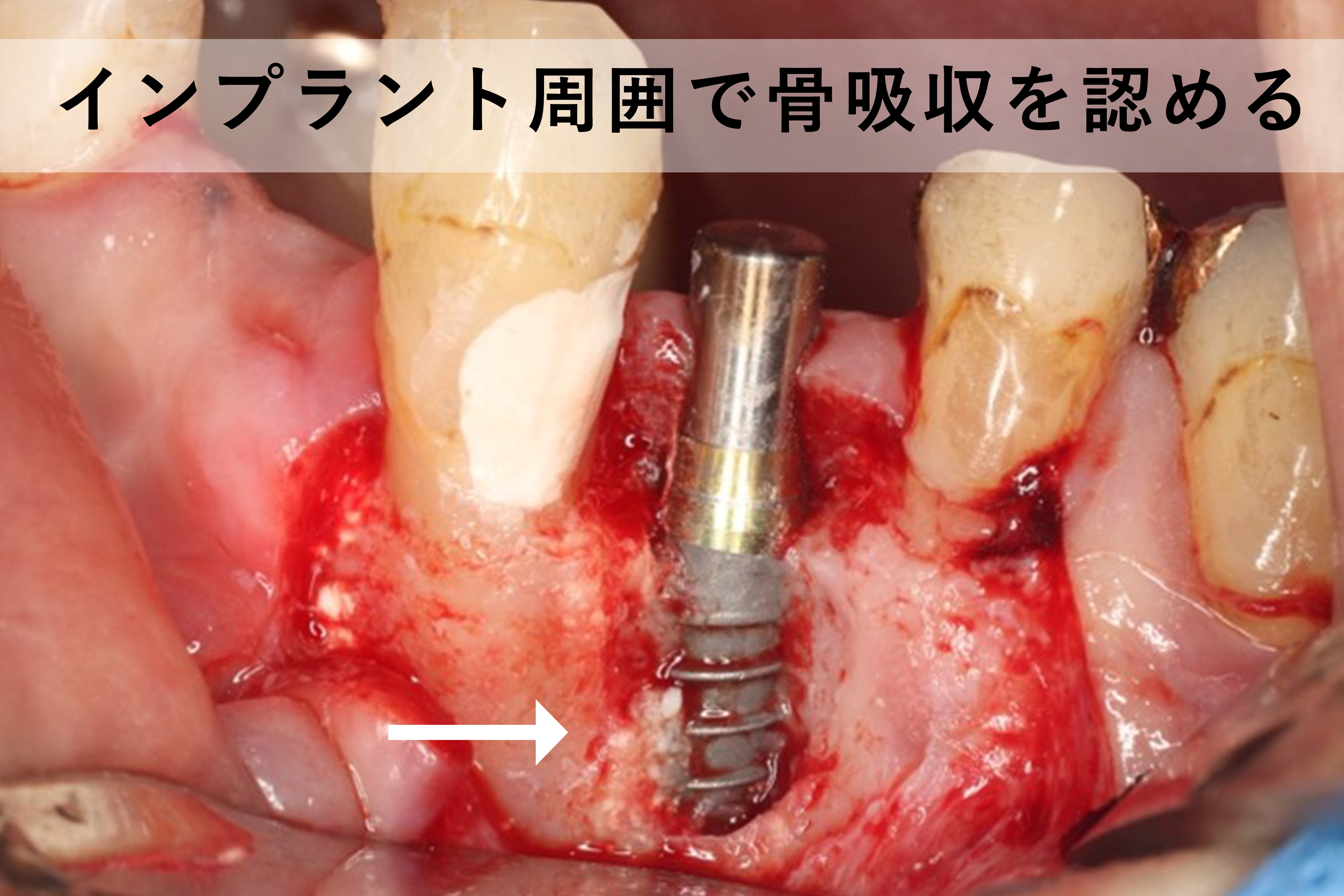 インプラント周囲で骨の吸収を認められた実際の歯ぐきの写真