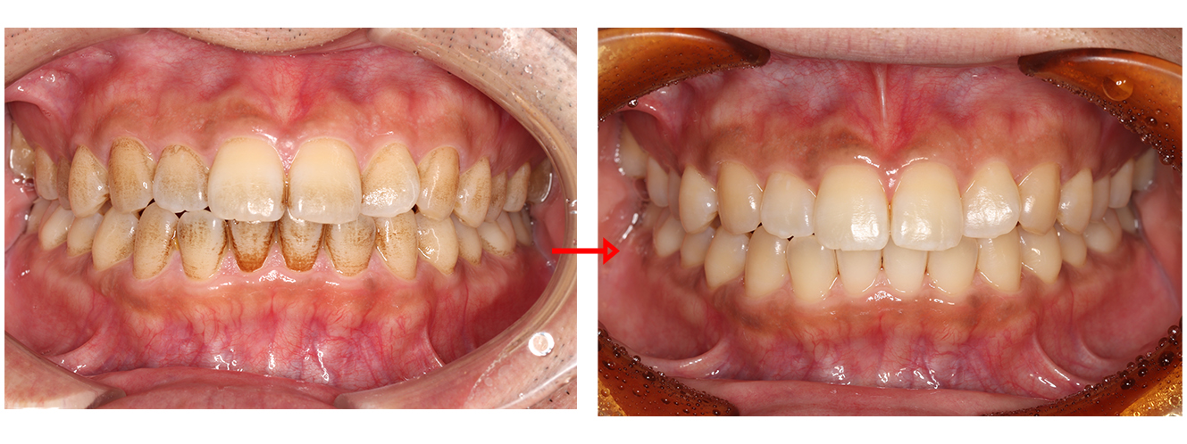 着色汚れがある歯の写真と、エアフローを使用した改善された写真