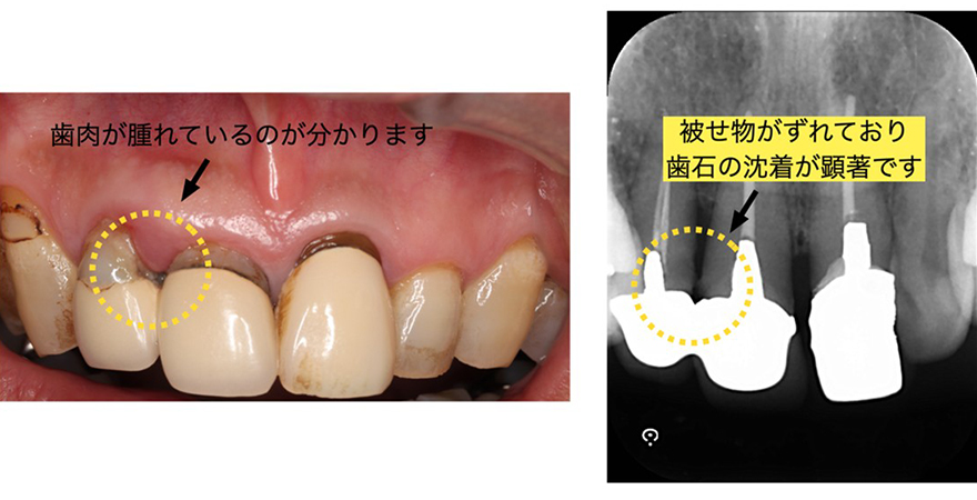 フィットしていないクラウンの写真