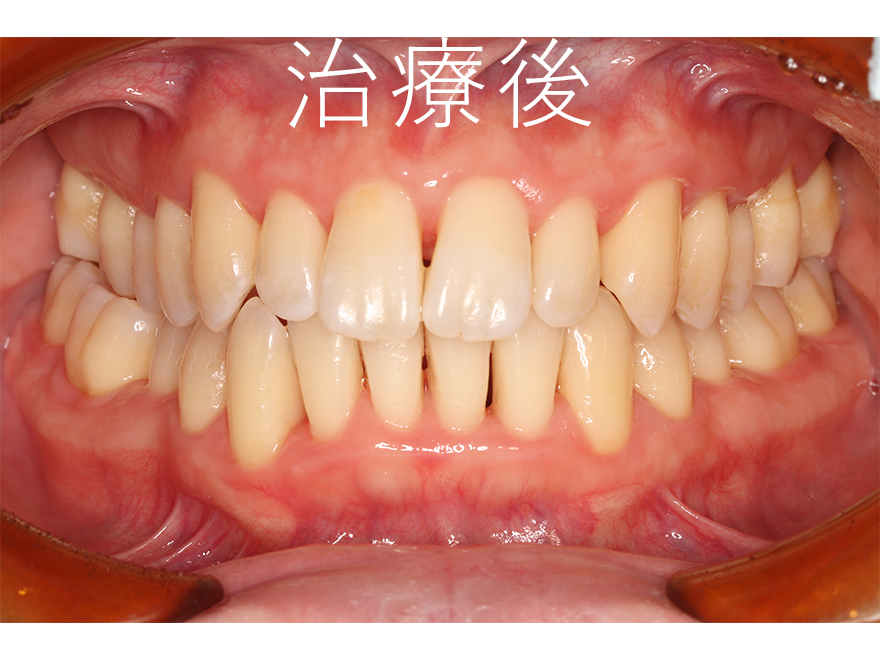 中程度の歯周炎の改善症例　治療後