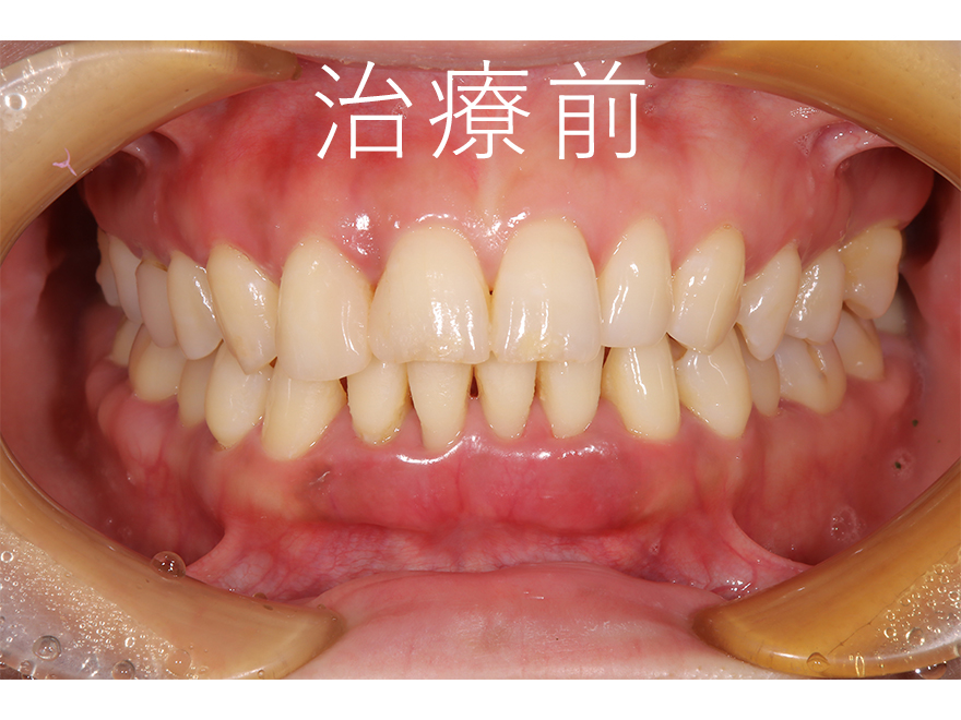 重度の歯周炎の改善症例　治療前