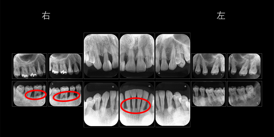 重度の歯周炎の改善症例　レントゲン写真