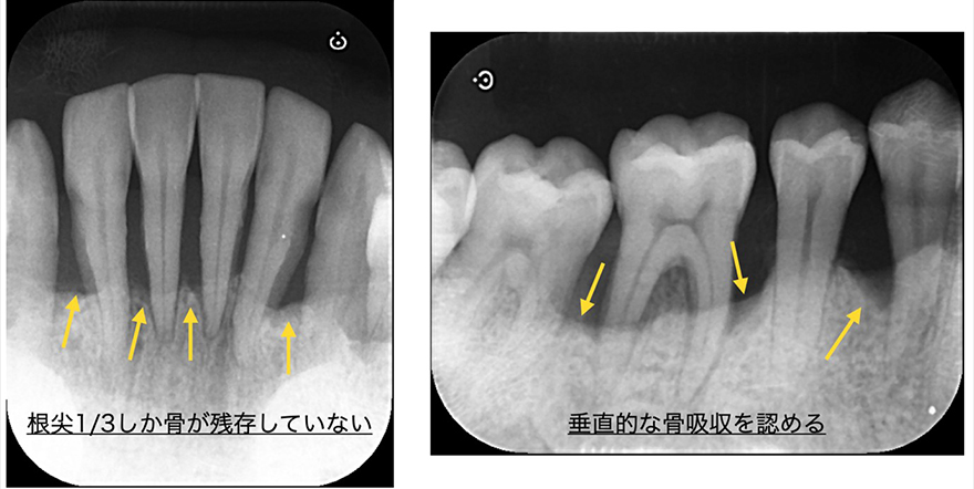 骨の吸収がわかる　レントゲン写真