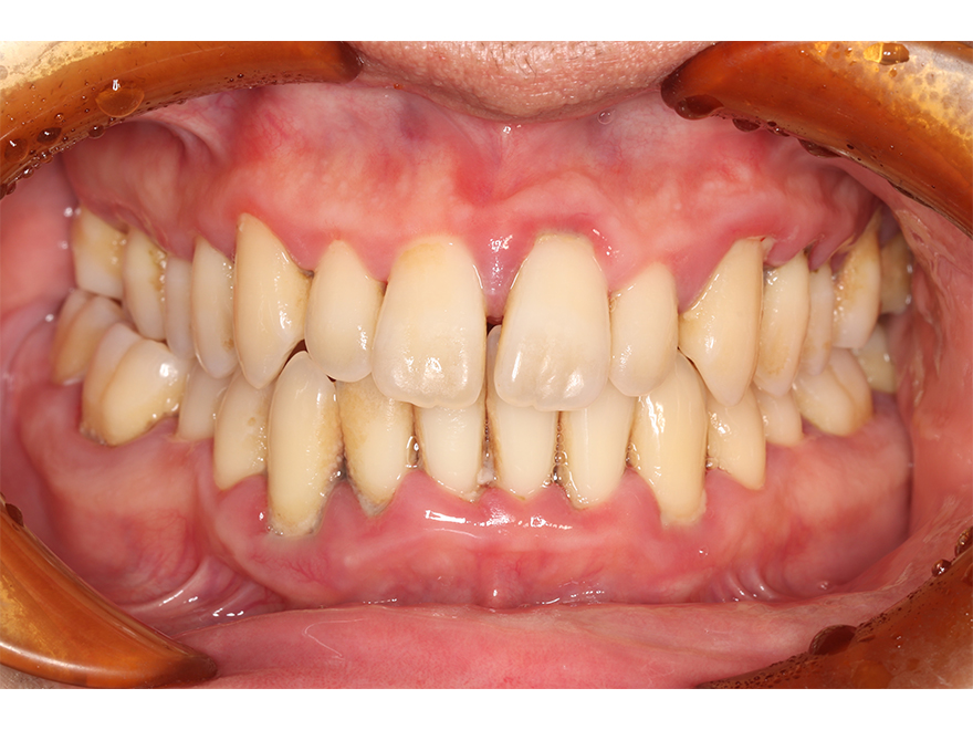 中程度の歯周炎の改善症例