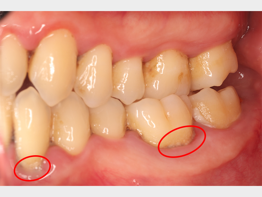 中程度の歯周炎の改善症例　炎症がよくわかる